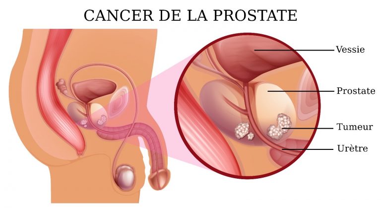 Cancer de la prostate par l'urologue Stephane Adjiman