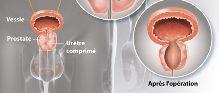 hypertrophie de la prostate et augmentation psa