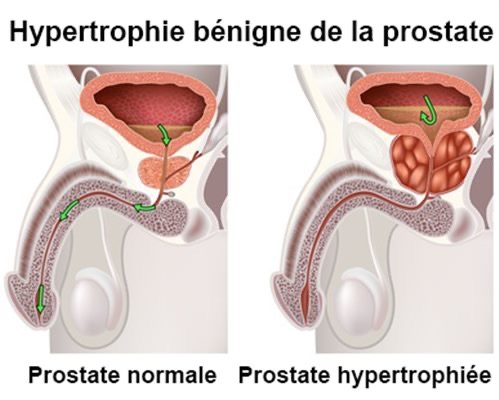 hypertrophie de la prostate et augmentation psa