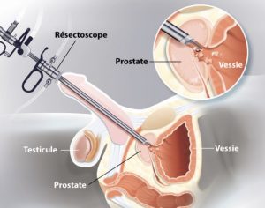 adénome de la prostate traitement